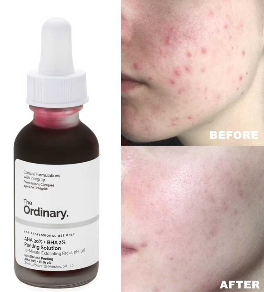 Peeling solution 30 mL, marca The Ordinary