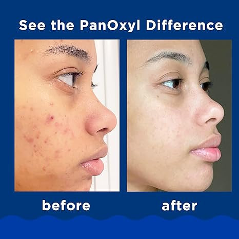 Acne cleansing cream, PANOXYL brand.